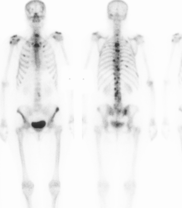 Bone Scan Multiple Metastasis